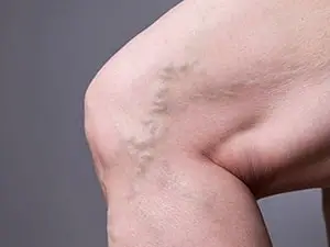 O que são varizes e vasinhos?