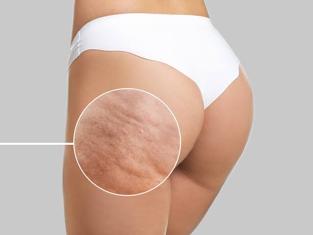 Tratamento para Celulite