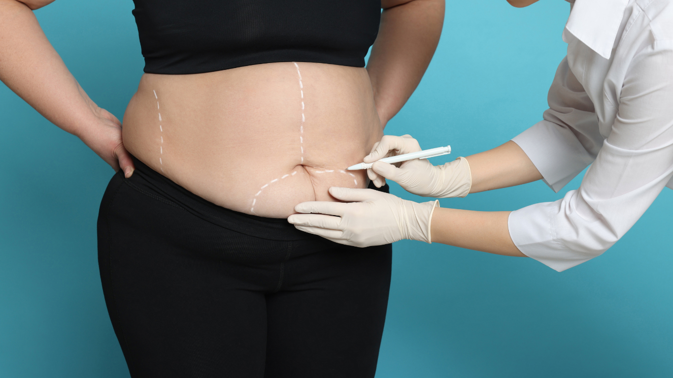 Pré e Pós Cirurgia Bariátrica